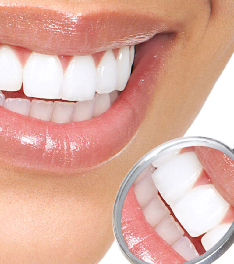 Porcelain Laminate Hala Medical Center