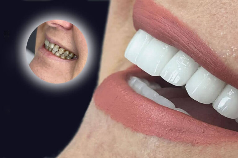 Top 9 Reasons To Have Zirconia Teeth Hala Medical Center